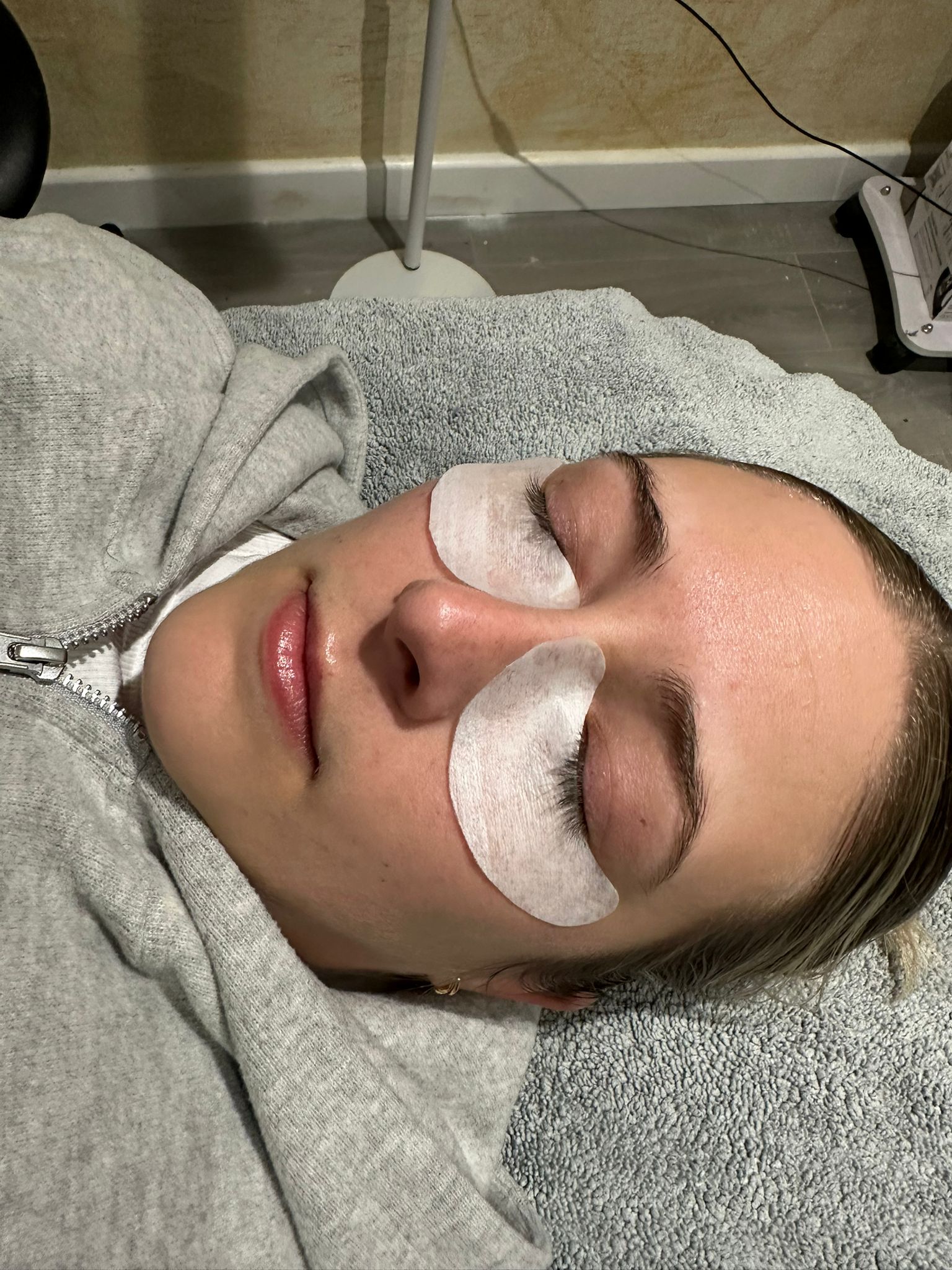 Cheek filler treatment at Libra Beauty Clinic